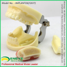 VERKAUFEN 12617 Implantatübungs-Kiefermodell mit austauschbarem Schaft